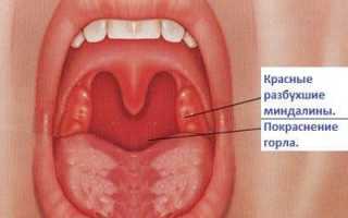 Лечение кашля при ангине