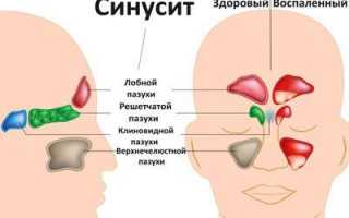 Чем лечить синусит в домашних условиях