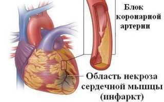 Механизм развития инфаркта лёгкого: симптомы патологии, принципы лечения