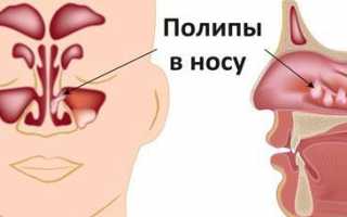 Симптомы и лечение полипов в носу