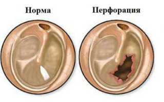 Симптомы и лечение перфорации барабанной перепонки