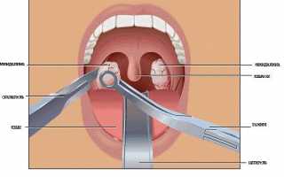 Нужно ли удалять миндалины при хроническом тонзиллите