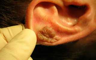 Причины рака уха, характерные симптомы и методы лечения