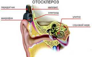 Причины отосклероза уха: диагностика и лечение