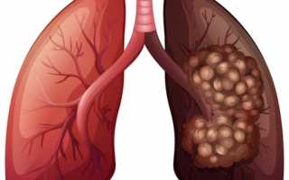 Рак лёгких: как определить наличие заболевания