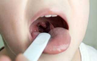 Симптомы и лечение лакунарной ангины у детей