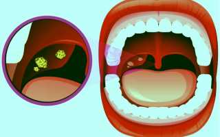 Симптомы и лечение хронического тонзиллита у взрослых