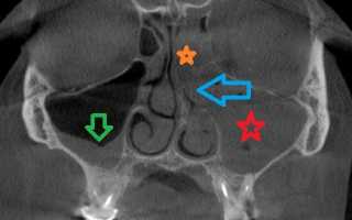 Признаки тотального и субтотального затемнения гайморовых пазух