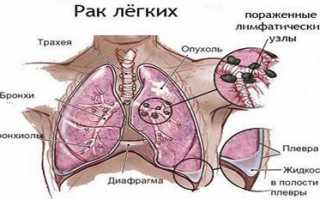 Особенности плоскоклеточного рака лёгких: формы, стадии, лечение и прогноз