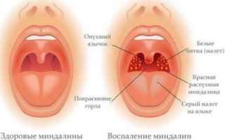 Симптомы и лечение герпеса в носу