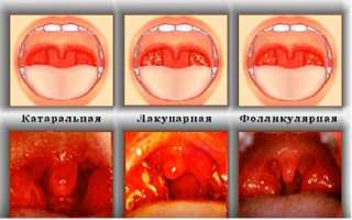 Симптомы и лечение острого тонзиллита