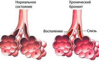 Проявления хронического бронхита у детей