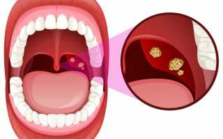 Патологии лор-органов – признаки и лечение воспаления аденоидов