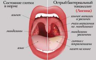 Каковы отличия ангины от ОРВИ и других схожих заболеваний