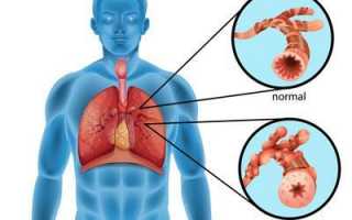 Кашлевая форма бронхиальной астмы – признаки и лечение