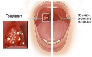 Патогенез и лечение тонзилитных пробок в горле