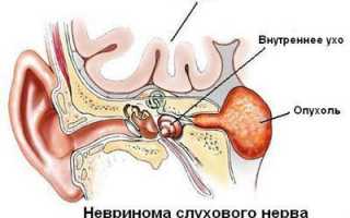 Невринома слухового нерва: симптомы, лечение и особенности опухоли