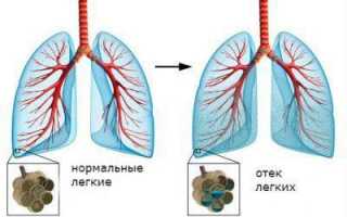 Как проявляется гиповентиляция лёгких