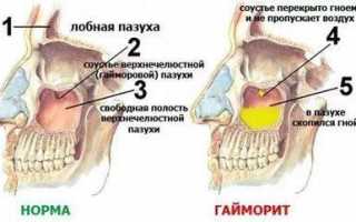 Какого цвета выделения из носа при гайморите