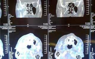 Магнитно-резонансная томография горла и гортани