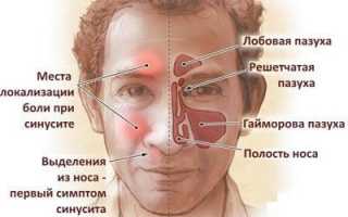 Понятие, виды и характерная симптоматика полисинусита