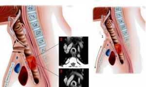 Острый и хронический стеноз гортани у взрослых: диагностика и лечение