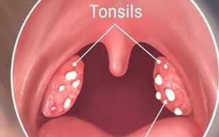 Что означают белые точки на миндалинах