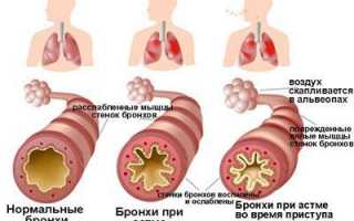 Астма у беременной женщины