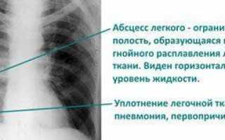 Причины, диагностика и лечение зелёной мокроты при кашле