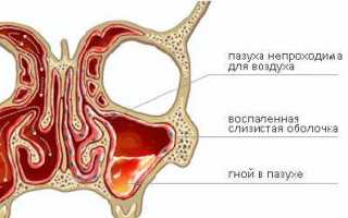 Признаки риносинусита в детском возрасте и его лечение