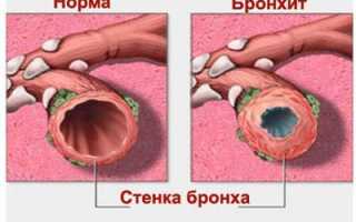 Действие муколитических средств: лучшие муколитики