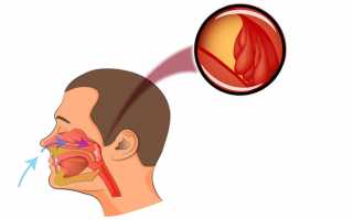 Симптомы и лечение воспаления носоглотки