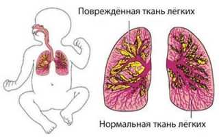 Причины и лечение внутриутробной пневмонии у новорождённых