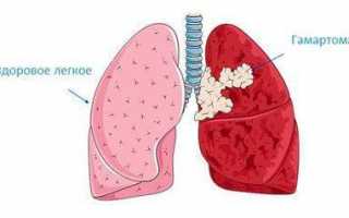 Гамартома лёгкого: причины, симптомы и лечение