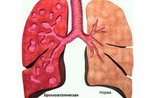 Симптомы и лечение разрыва лёгкого