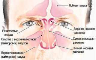 Виды, симптомы и лечение гайморита в домашних условиях