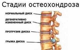 Почему болят уши при остеохондрозе