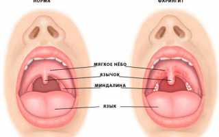 Причины и лечение воспаления горла и гортани
