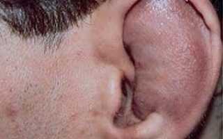 Причины и признаки, особенности лечения перихондрита ушной раковины