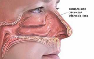 Причины и лечение воспаления слизистой носа