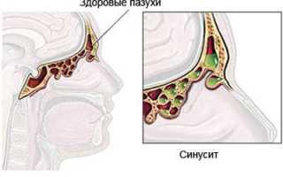 Симптомы и лечение атрофического ринита