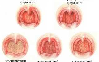 Разновидности инфекций горла и способы их лечения