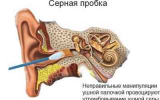 Тугоухость кондуктивного типа: причины, симптомы, степени и лечение