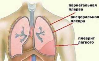 Плеврит легких как вторичный признак при опухолях